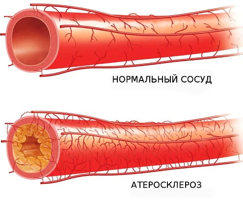 Атеросклероз